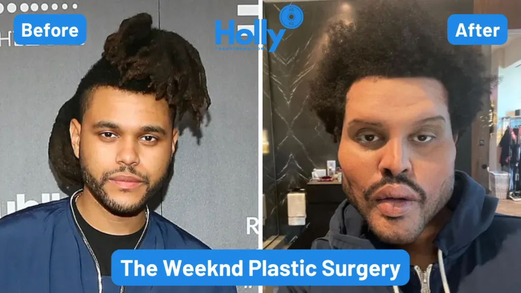 The Weeknd Plastic Surgery Transformation Before and After Image. In the left his face seems natural and in the right his face seems like he has undergone plastic surgery.