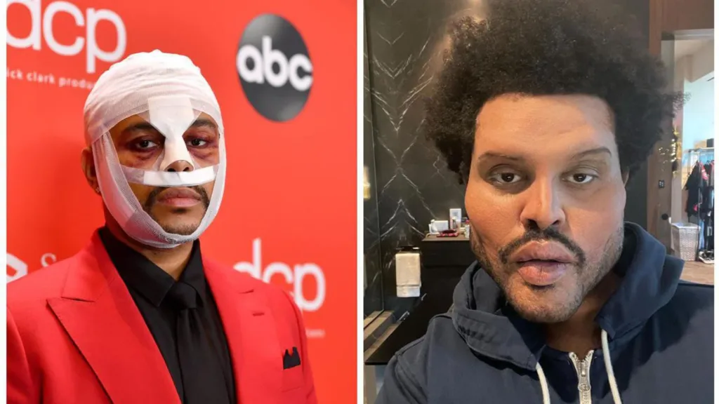 The Weeknd Plastic Surgery Transformation. In one image he is seen wearing bandages and in the right image his lips and face seems like has undergone some surgical procedures.