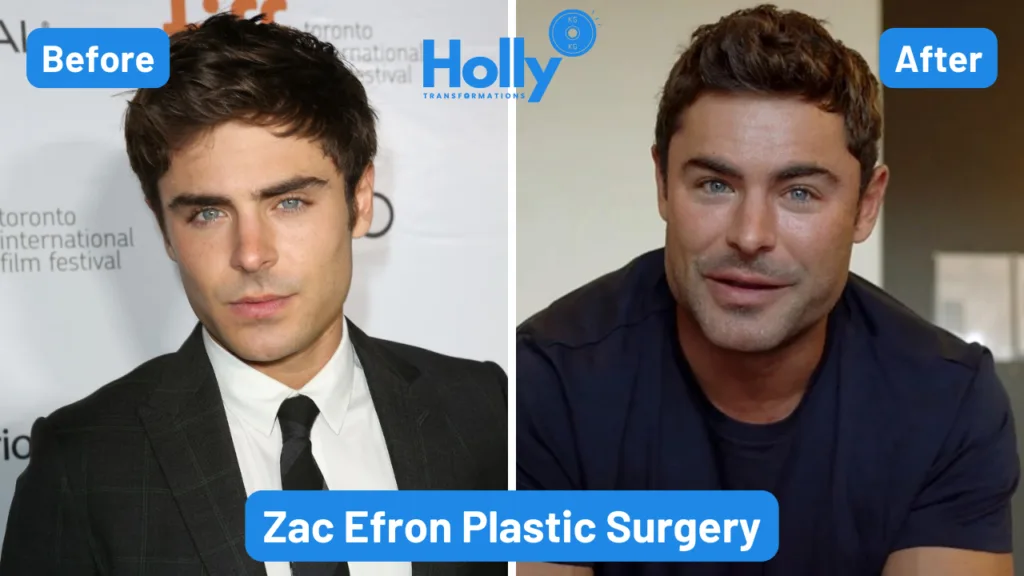 Zac Efron Plastic Surgery Transformation Before and After